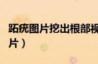 跖疣图片挖出根部视频（跖疣图片挖出根部图片）