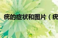 疣的症状和图片（疣分几种 各种疣的症状）