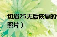 切眉25天后恢复的情况（切眉术后二十天的照片）