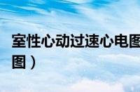 室性心动过速心电图图解（室性心动过速心电图）